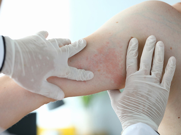You are currently viewing When is a drug rash more than just a rash?